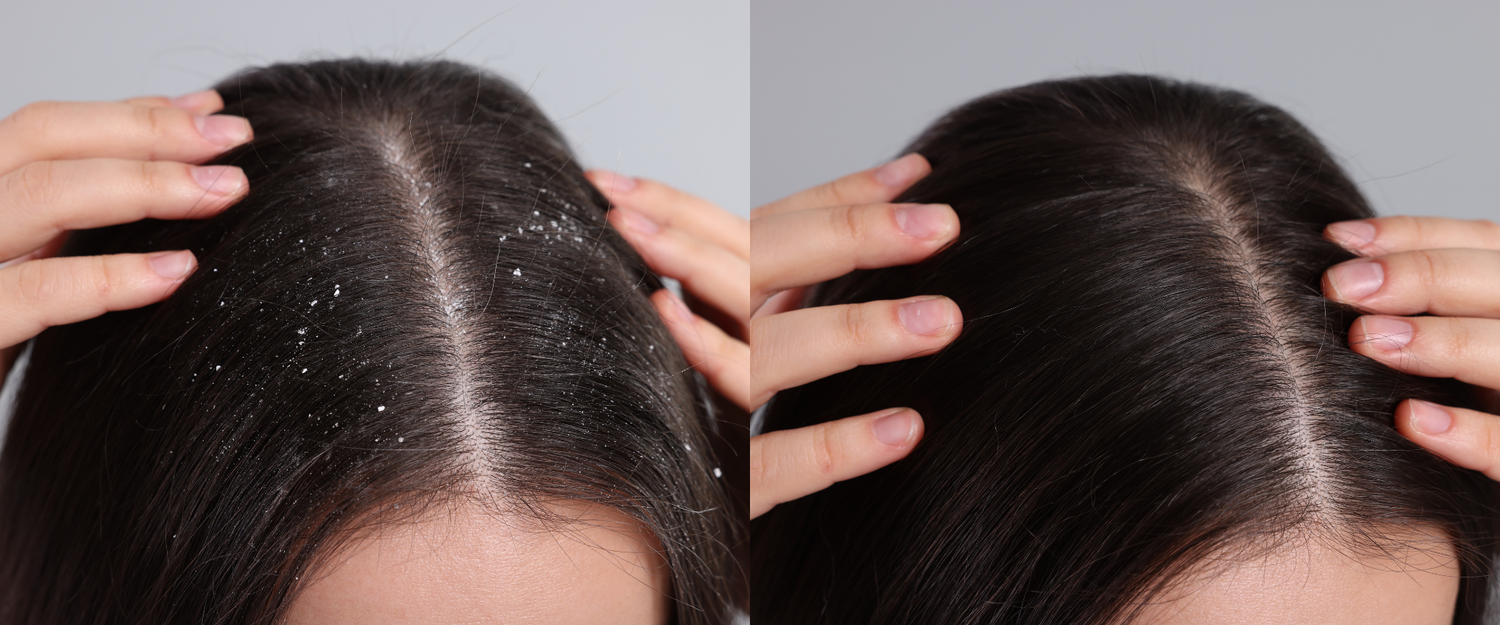 Finally, an anti-dandruff treatment that doesn’t irritate the scalp