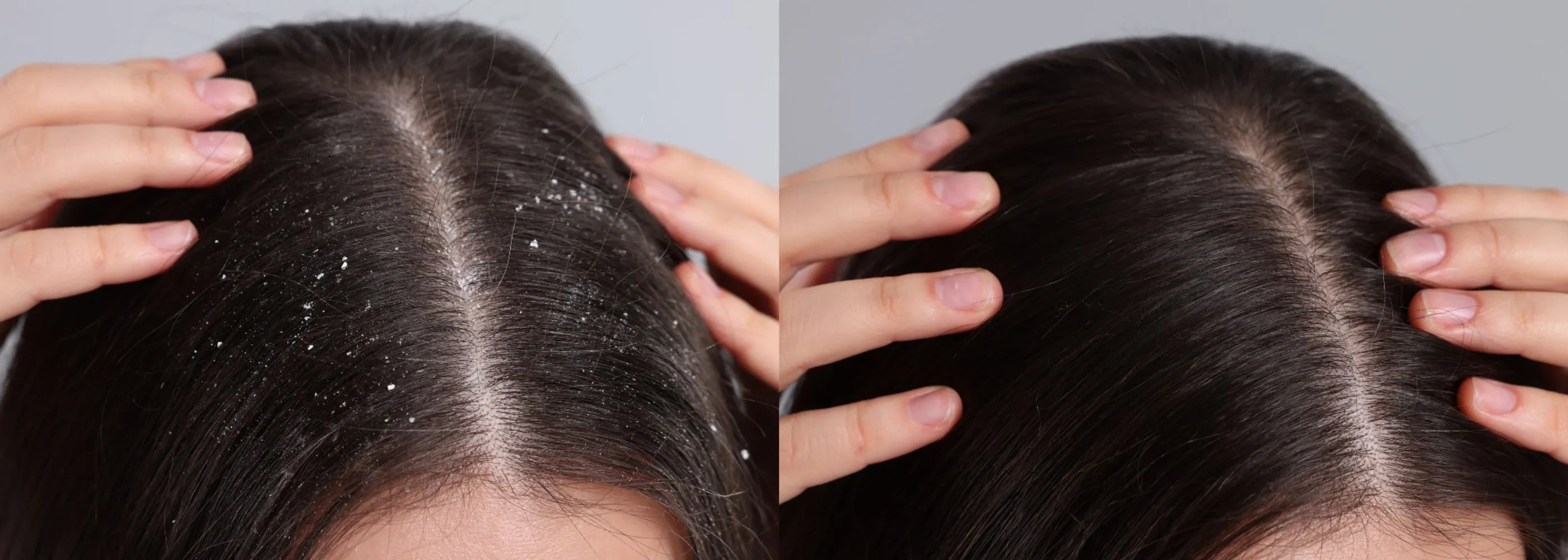 Before and after comparison of hair treatment on a person's head.